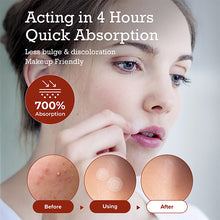 Load image into Gallery viewer, Pimple Lab Invisible Hydrocolloid Spot Patch / Pimple Patch (110 Patches)
